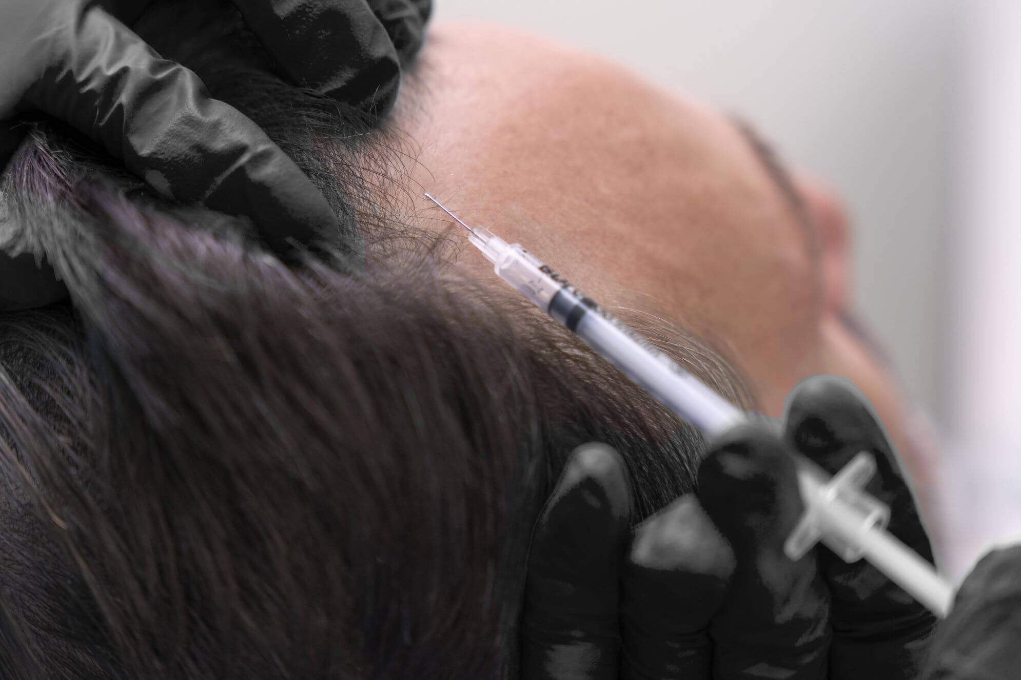 Aplicación de mesoterapia capilar con Dutasteride en el cuero cabelludo