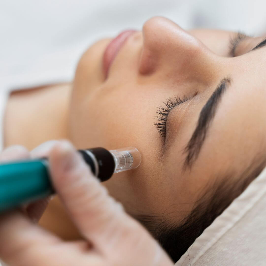 microneedling