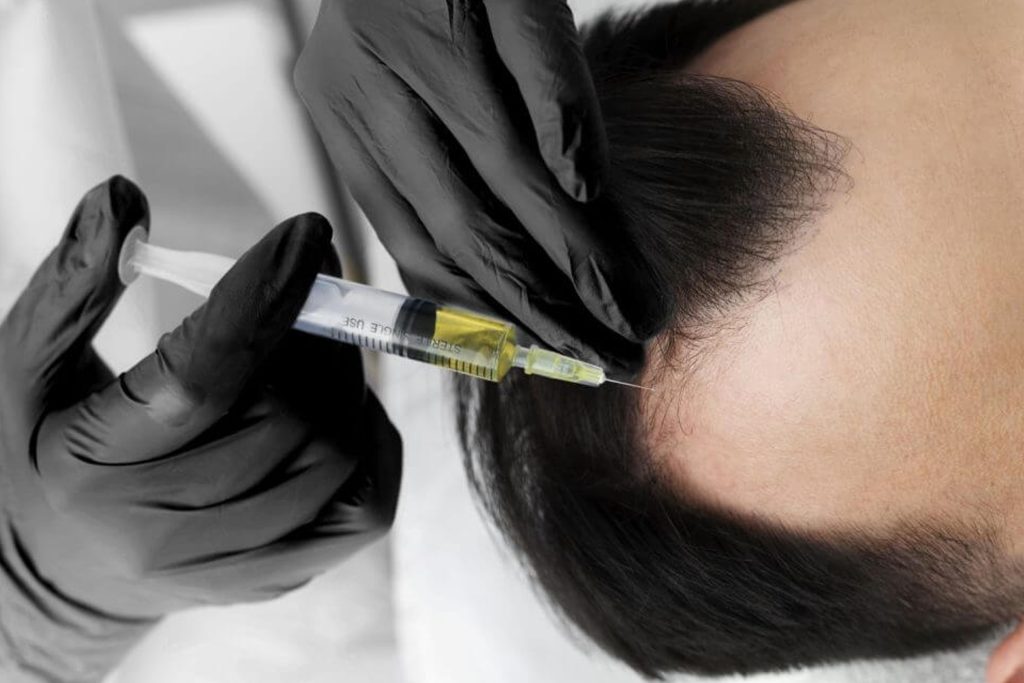 Aplicación de PRP capilar en el cuero cabelludo para estimular el crecimiento del cabello