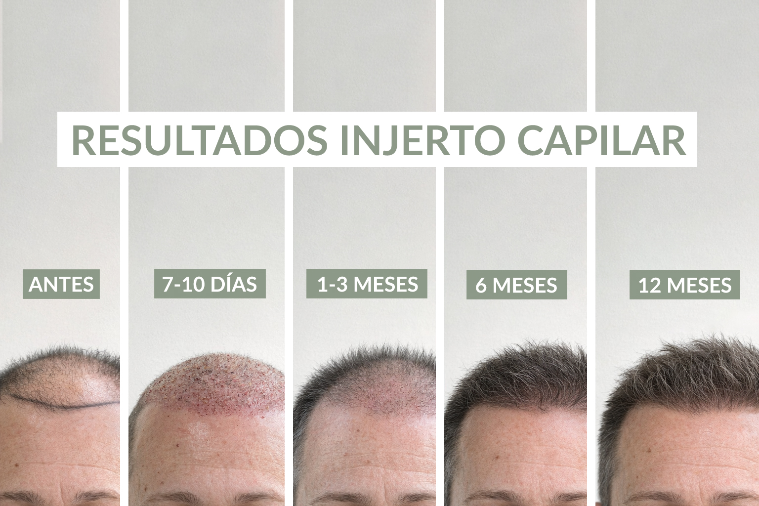 Evolución de los resultados de un injerto capilar a los 3, 6, 9 y 12 meses